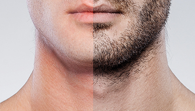 A man’s face split in half, half his face without a beard, and half with, to demonstrate what a Hair Restoration Specialist in New Jersey can do