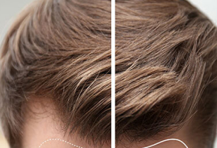 A split-screen view demonstrates a brunette man’s scalp, before and after receiving a follicular unit transplant in New Jersey