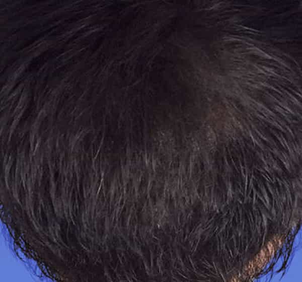 A man displays a full, healthy head of hair after finding the best hair transplant doctor near me