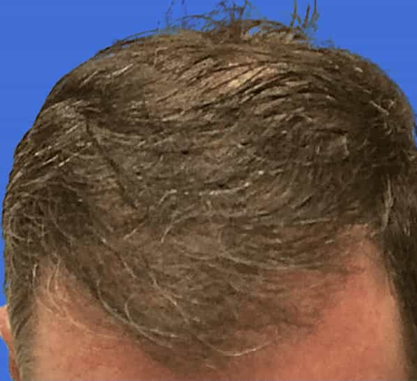 A brunette man displays a full head of hair after finding the best hair transplant doctor near me