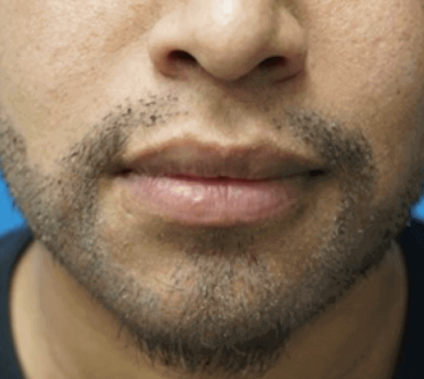 Frontal view of a man’s lips and chin after having a Beard Transplant in New Jersey