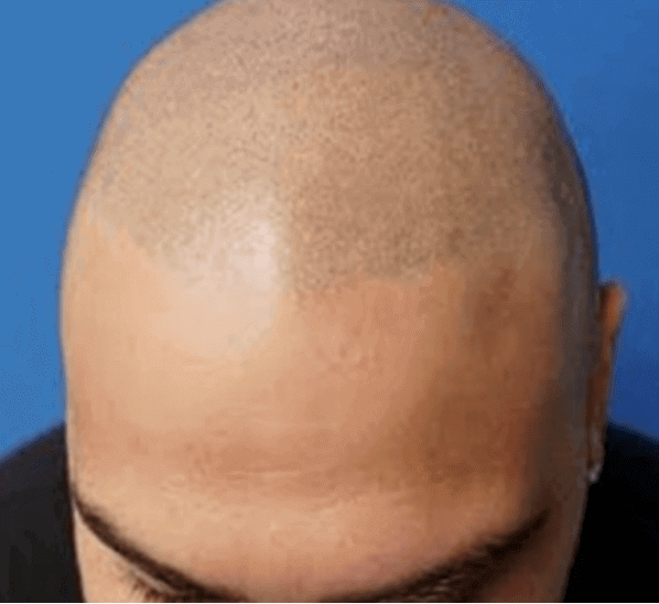 A man shows off his freshly micro pigmented scalp after finding a hair transplant doctor near me