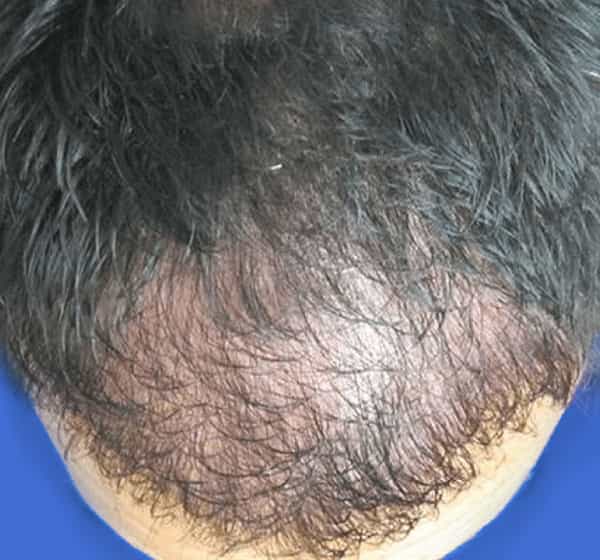 A bird’s-eye view of a man with thinning hair on his scalp who needs the best hair transplant doctor New Jersey