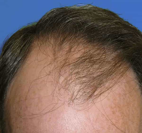A man with thinning hair on his scalp before seeking a hair transplant New Jersey