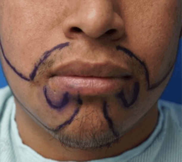 A man with lines drawn on his face for a beard transplant after searching best beard transplant near me