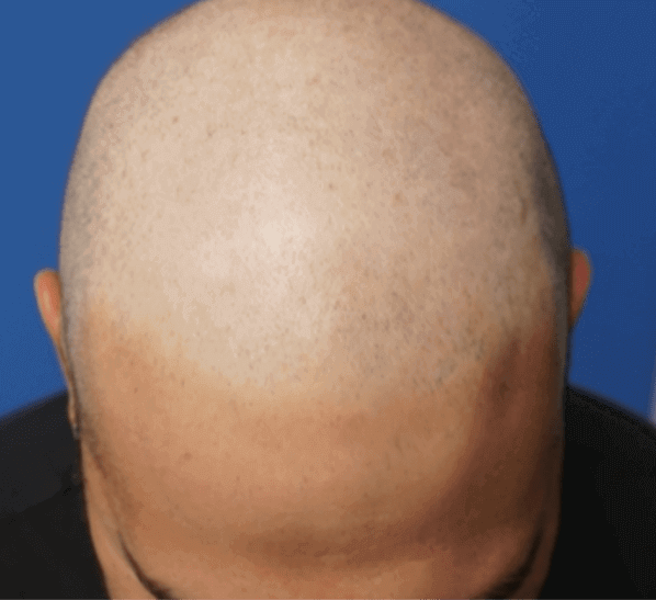 A bald man shows off his scalp before finding a hair transplant near me