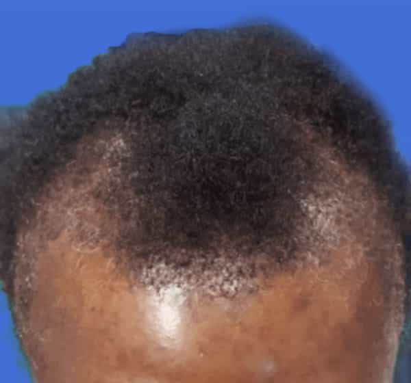 A man displays a receding hairline before finding a hair transplant near me