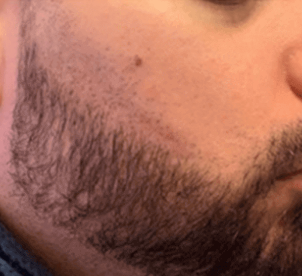 Man’s jawline and patchy beard before having a Beard Transplant by Dr. Ross, a beard transplant doctor Near Me