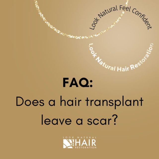 A very common patient question is: does a hair transplant leave a scar? 

In short, yes - FUE & FUT procedures leave a barely noticeable scar at the donor site where the hair follicles have been removed. For more info, visit our site FAQs (link in bio), & if you still have questions get in touch with us!

.
.
.
.
.

#hairtransplant #scarring #hairlosshelp #hairloss #scalpmicropigmentation #bald #hairlosssolution #hairlosstreatment #hairgrowth #postpartumhairloss #hairlosssolutions #damagedhair #hairtransplantation #baldhead #hairgrowthjourney #hairgrowthproducts #scalpcare #hairfinity #hairline #thinninghairsolution #alopecianbeauty #hairreplacementspecialist #alopeciaawareness #hairdoctor #thinninghair #hairlossspecialist #scalp #looknaturalhairrestoration #newjersey #newyork