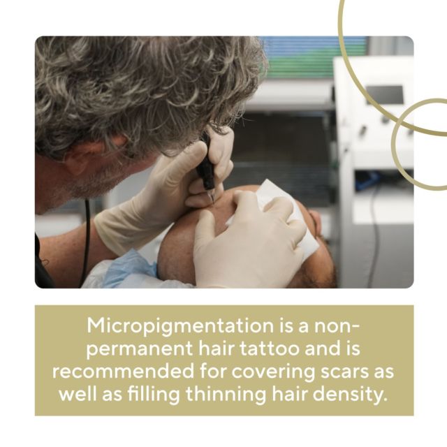 Micropigmentation is a non-permanent hair tattoo and is recommended for covering scars, as well as filling thinning hair density. It can be a great option for anyone who is experiencing the earliest stages of thinning hair.

Considering this as a treatment? Contact Dr. Ross today to schedule your consultation and have all of your questions answered!

.
.
.
.
.

#micropigmentation #thinninghairsolution #scalpmicropigmentation #hairloss #hairtransplant #hairlosssolution #hairlosssolutions #hairlosstreatment #hairlosshelp #thinninghair #baldness #scalp #hairline #hairlossspecialist #scalptreatment #bald #hairsolution #hairlossclinic #nohair #nonsurgicalhairreplacement #scalptattoo #hairsolutions #scalpcare #hairlosstreatments #hairlinetattoo #looknaturalhairrestoration #newjersey #newyork