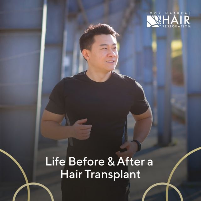 If you've started to consider getting a hair transplant, then you have probably already had many questions come up. You're definitely not alone. Check out our recent blog post (link in bio) to read about what life might be like before & after a hair transplant 🧑🏼‍🦲

.
.
.
.
.

#newblogpost #hairtransplant #hairloss #hairlosssolution #scalpmicropigmentation #hairlosstreatment #scalpcare #bald #hairlosssolutions #hairtransplantation #hairlosshelp #thinninghairsolution #hairline #hairfinity #hairgrowth #hairreplacementspecialist #hairreplacement #baldhead #hairdoctor #fue #hairlossspecialist #scalp #thinninghair #baldness #thinhairsolution #menshairloss #blog #looknaturalhairrestoration #newjersey #newyork