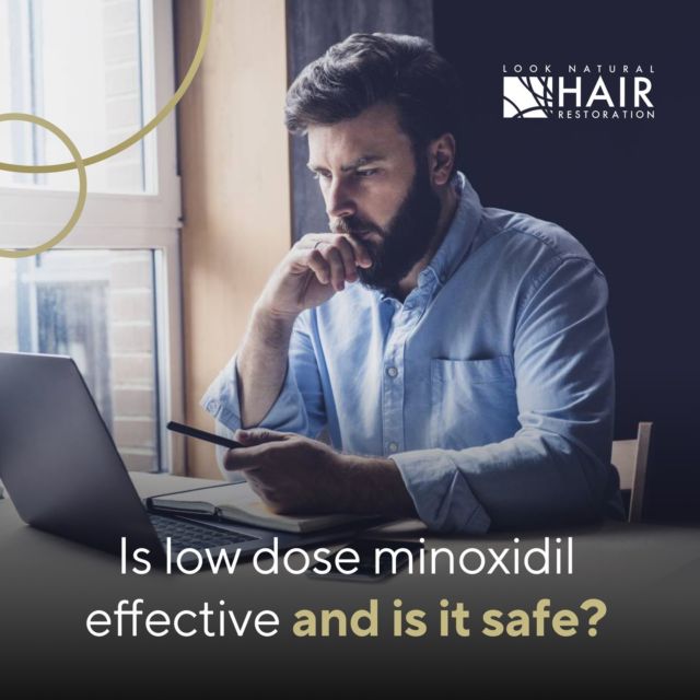 We've been getting a lot of questions recently about low dose minoxidil as a hair loss treatment after a recent article was published in the NY Times. Two of the most frequent questions we've been getting are: Is it effective and is it safe?

Let's address the efficacy question first: is low dose oral minoxidil an effective treatment for hair loss? 

According to a literature review published in the International Journal of Dermatology, low dose oral minoxidil (LDOM) is a highly effective treatment for thinning hair and hair loss. Ten articles were included in the review comprising a total 19,218 patients (215 women and 19,003 men). 

Patients with androgenic alopecia responded best to the treatment with 61-100% of those patients demonstrating clinical improvement but LDOM was also effective in alopecia areata where 18-82.4% of patients demonstrated objective clinical improvement depending on the study.

So, since LDOM is effective, is it safe?

According to a review published in the Journal of the American Academy of Dermatology, low dose oral minoxidil is a safe treatment option for thinning hair and hair loss. The review included a total of 1404 patients (943 women and 461 men). 

Although the most frequent side effects were hypertrichosis and lightheadedness, systemic adverse effects were mild in the majority of cases and only 1.7% of patients stopped treatment because of these effects. 

So, low dose oral minoxidil is both safe and effective. 

Still have questions? Call for a consultation to see if this is the right treatment option for you.

#minoxidil #LDOM #hairlosssolution #hairloss #hairtransplant #hairlosstreatment #hairlosshelp #thinninghair #hairreplacement #hairtransplantation #hairlossspecialist