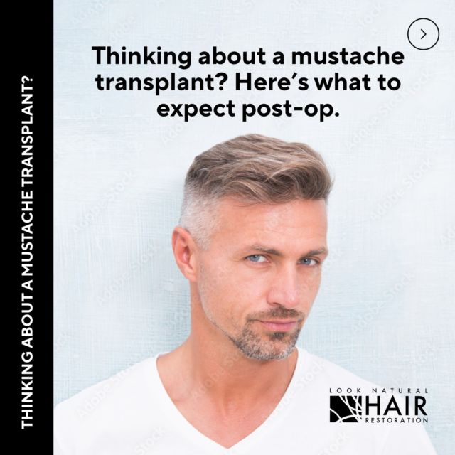 Thinking about a mustache transplant? Here’s what you want to know. Follow @looknaturalhairrestoration & contact Dr. Ross to find out more (855) 802-4247. 

#mustache #hairstransplant #looknaturalhairrestoration