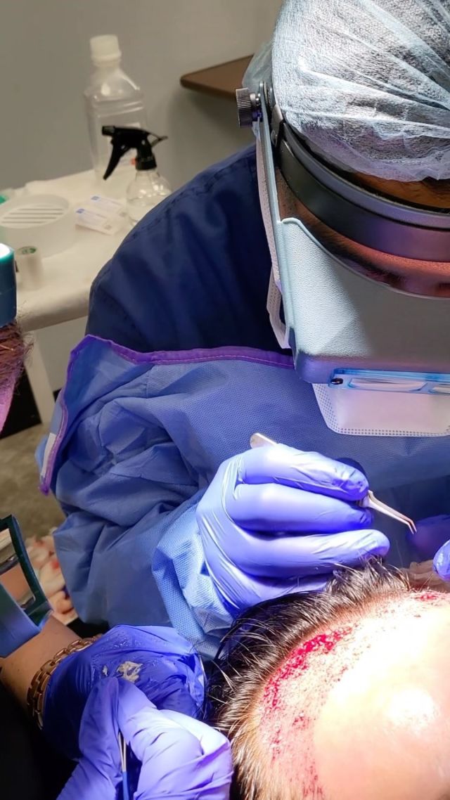 Check out our team during surgery before heading out for some Friday action 🍻 What’s on your agenda this weekend? 

#hairtransplant #hairrestoration #fridayfun #looknaturalhairrestoration