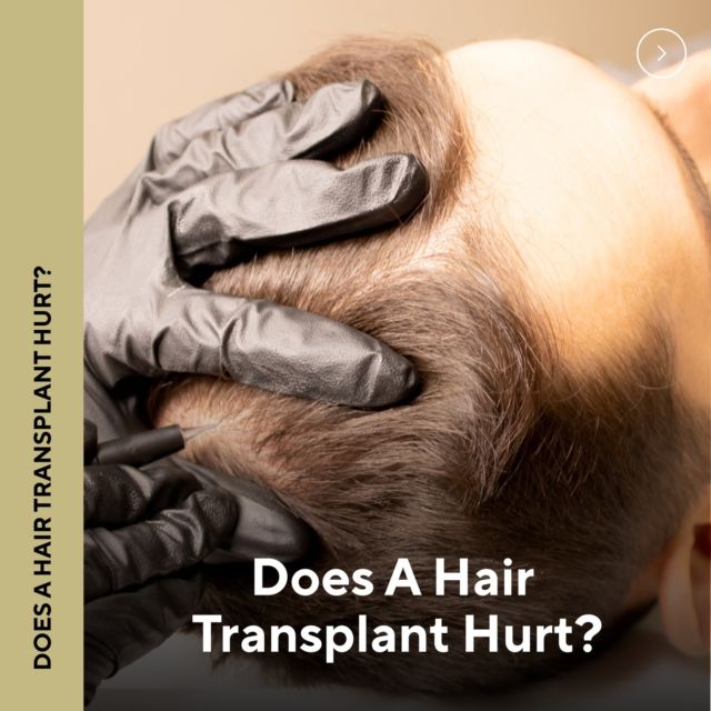 We get asked this question often: does a hair transplant hurt? Keep scrolling to find out. And if you have more questions, visit the FAQs on our site: 

https://looknaturalhairrestoration.com/faqs/

#hairtransplant #hairrestoration #looknaturalhairrestoration