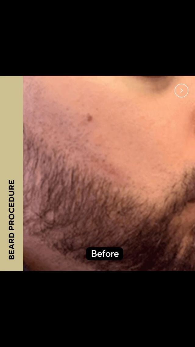 Check out this beard procedure. What do you think about the end result? Comment below to let us know! 

#beardprocedure #beardtransplant #beforeandafter #looknaturalhairrestoration
