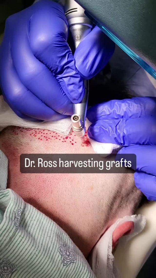 Here you can see Dr. Ross harvesting grafts for a hair transplant using a small instrument that's similar to a scalpel or needle. 

#harvestingrafts #hairtrranslpant #hairrestoration #looknaturalhairrestoration