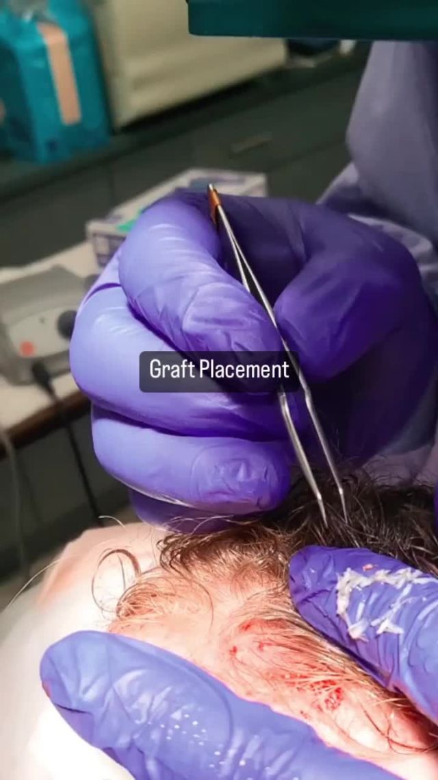 Graft placement is a part of the hair transplant process. After the recipient sites are prepared, individual hair grafts are placed at the same angle, so your hair grows naturally to ensure a seamless and natural look.

 #hairtrranslpant #FUE #FUT #hairrestoration #looknaturalhairrestoration